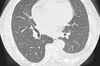 Tomografia płuc
