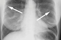 Rozedma płuc – leczenie